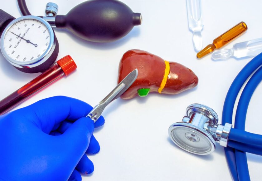 hepatectomía